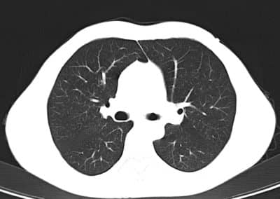 Röntgenaufnahme Lunge