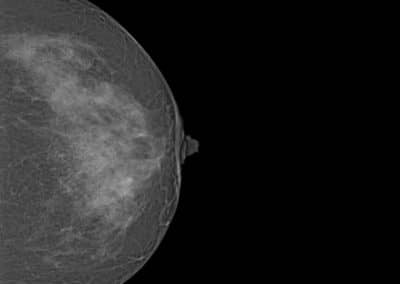 Système de mammographie Xenox S100